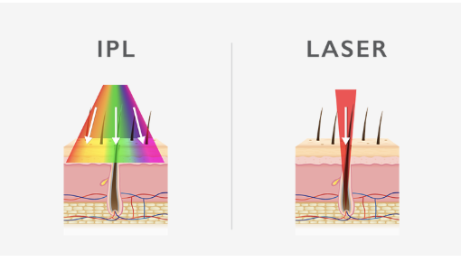 IPL vs Laser — Soprano Ice Platinum