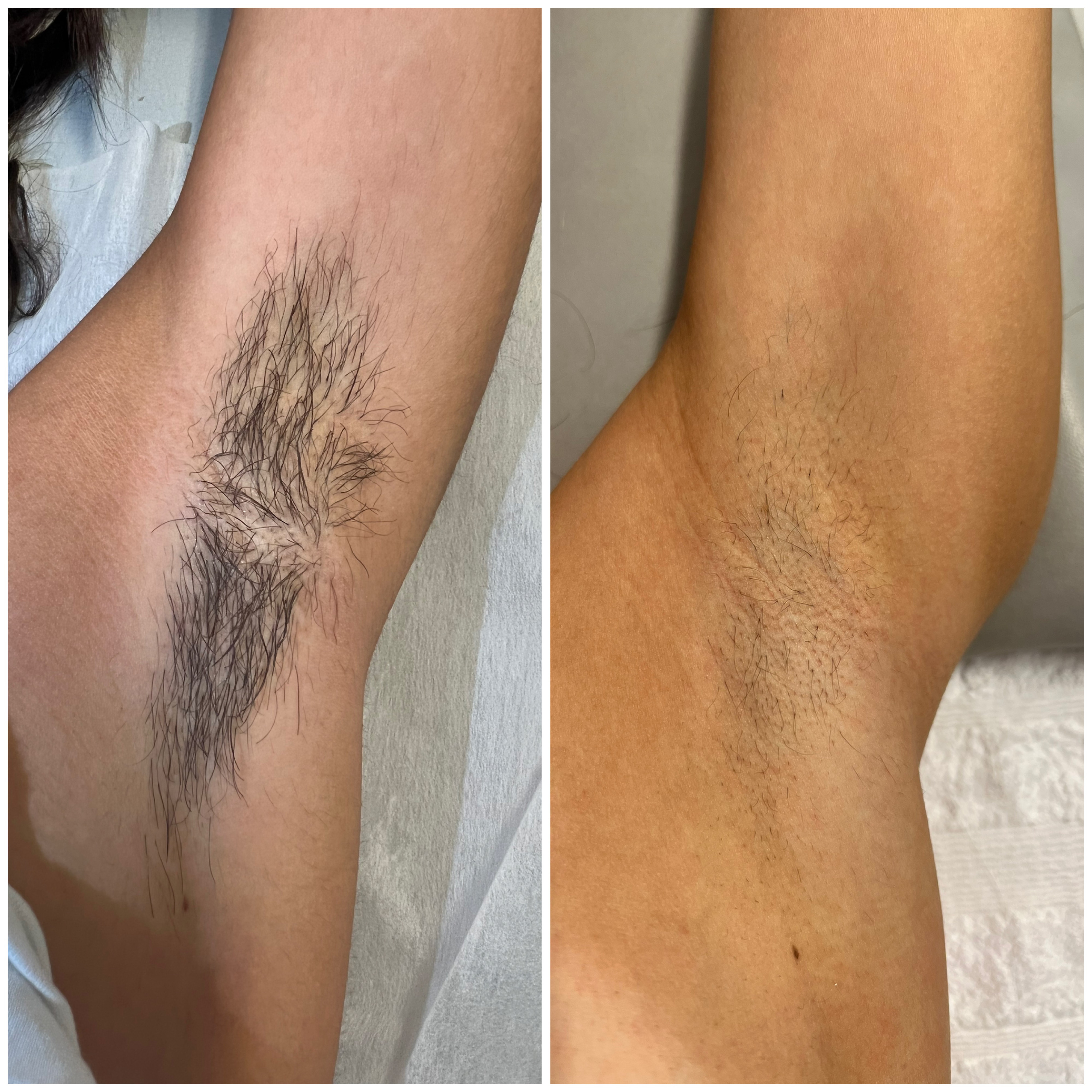 Laserbehandling — resultat 1