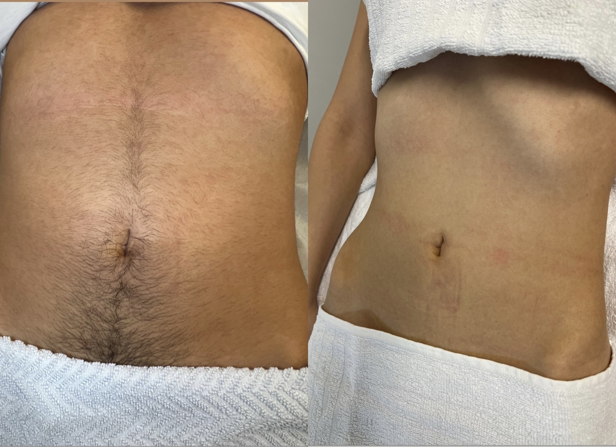 Laserbehandling — resultat 2