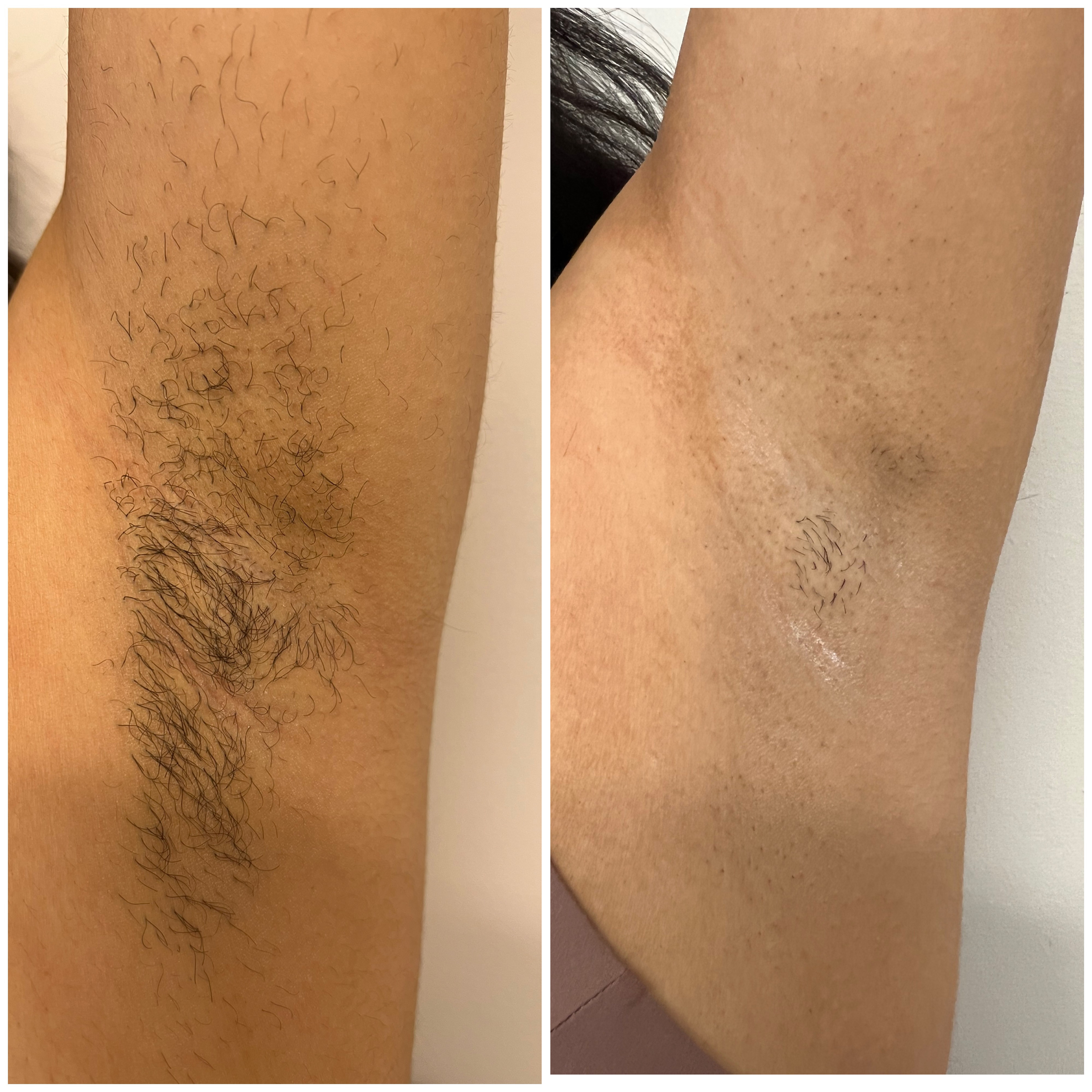 Laserbehandling — resultat 3
