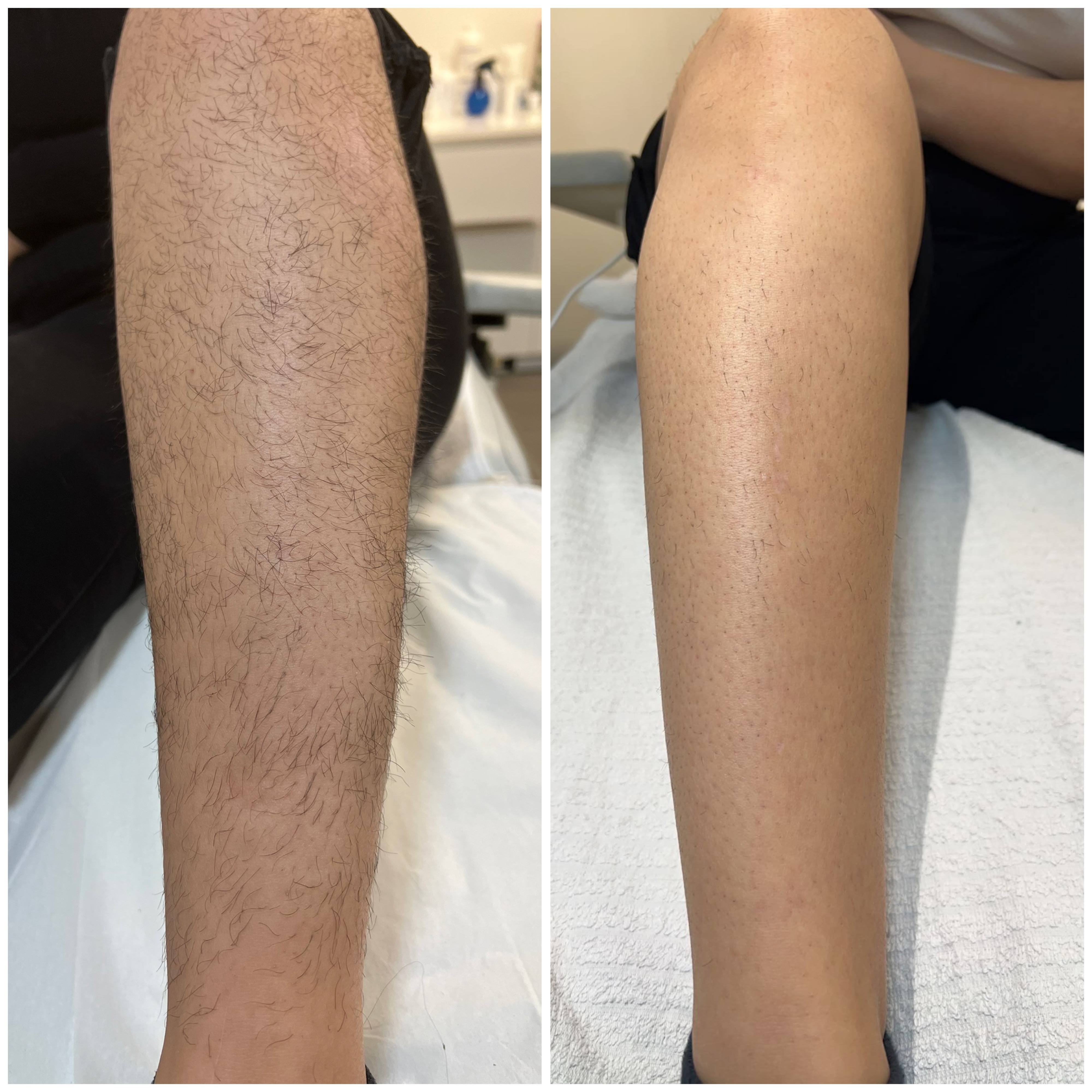 Laserbehandling — resultat 4