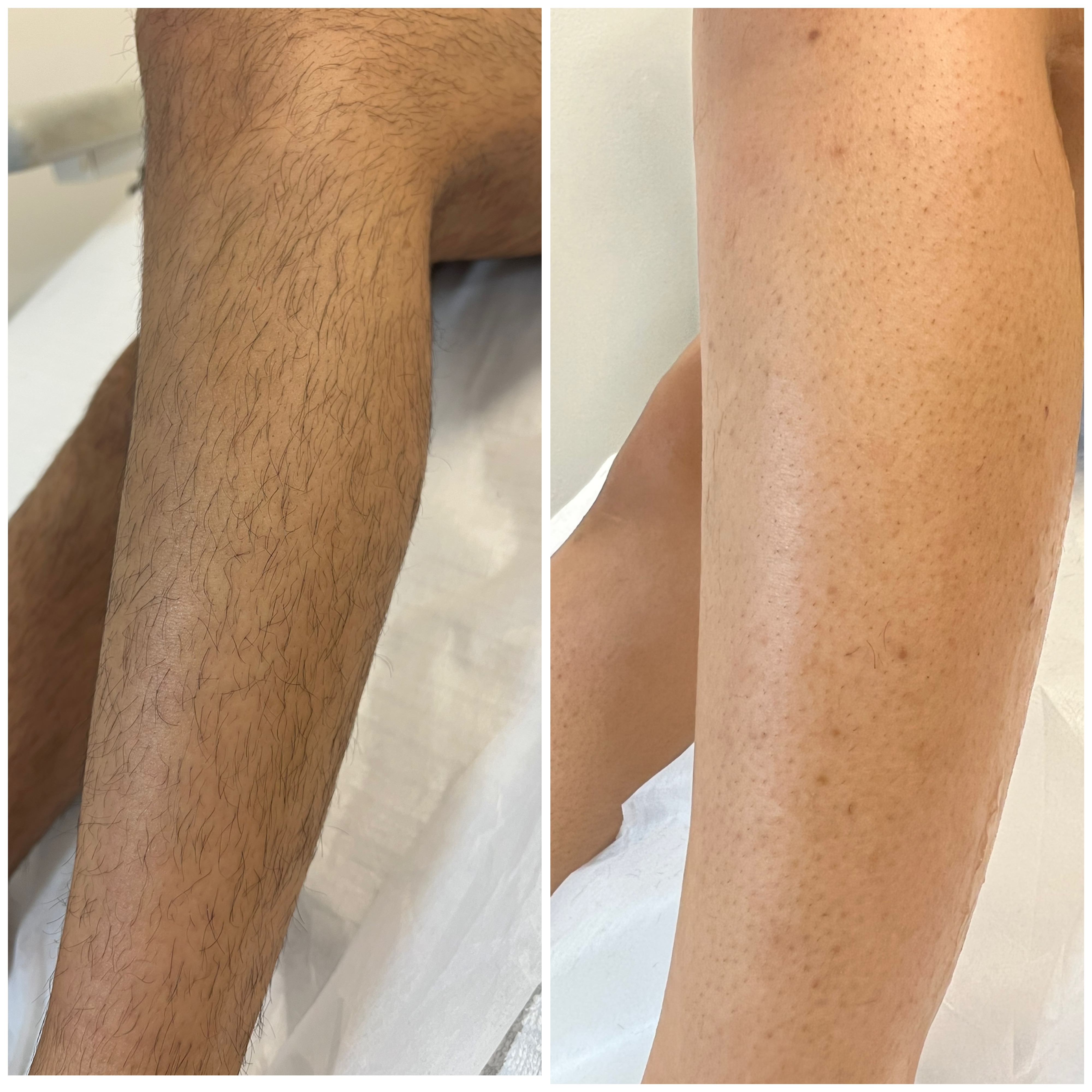 Laserbehandling — resultat 5