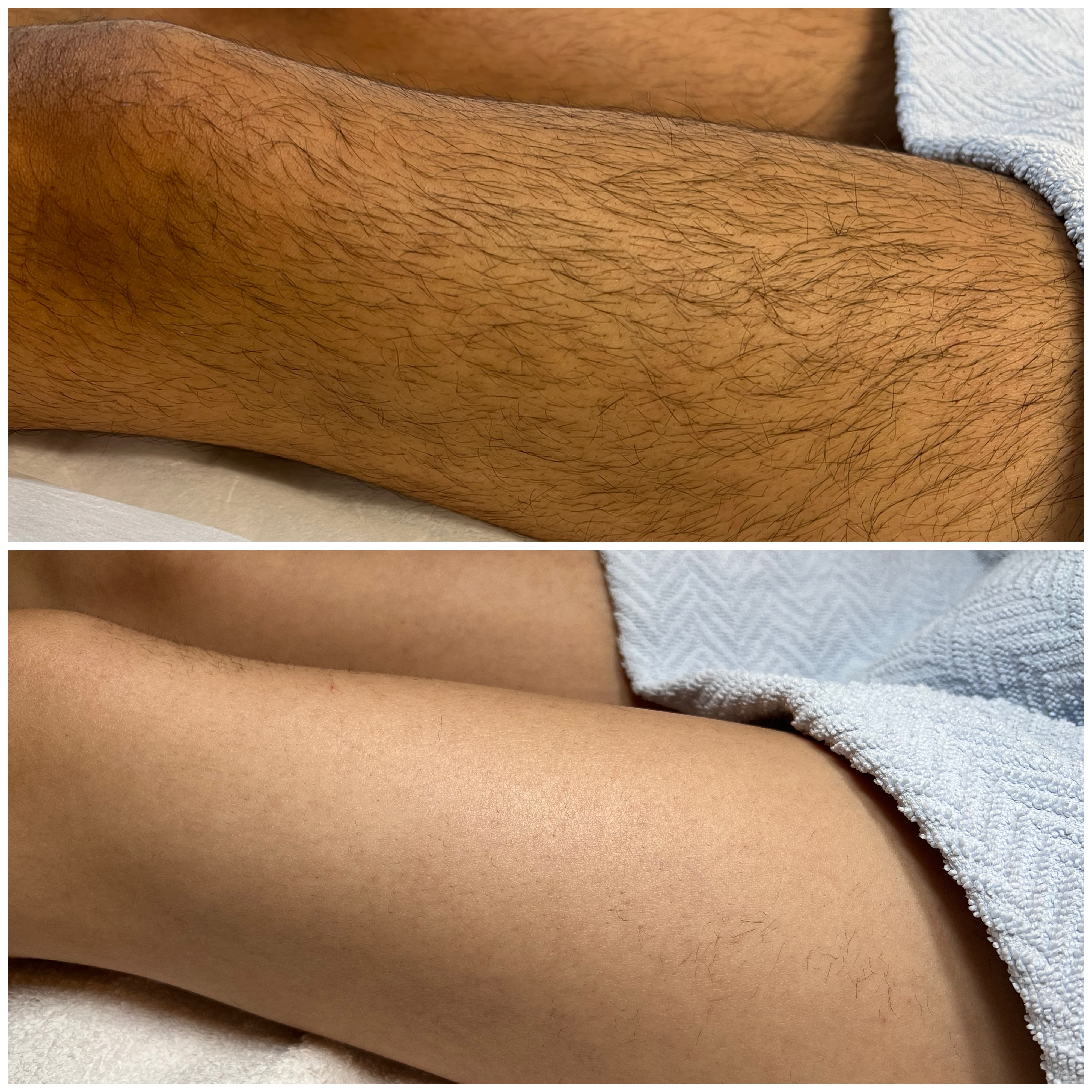 Laserbehandling — resultat 6