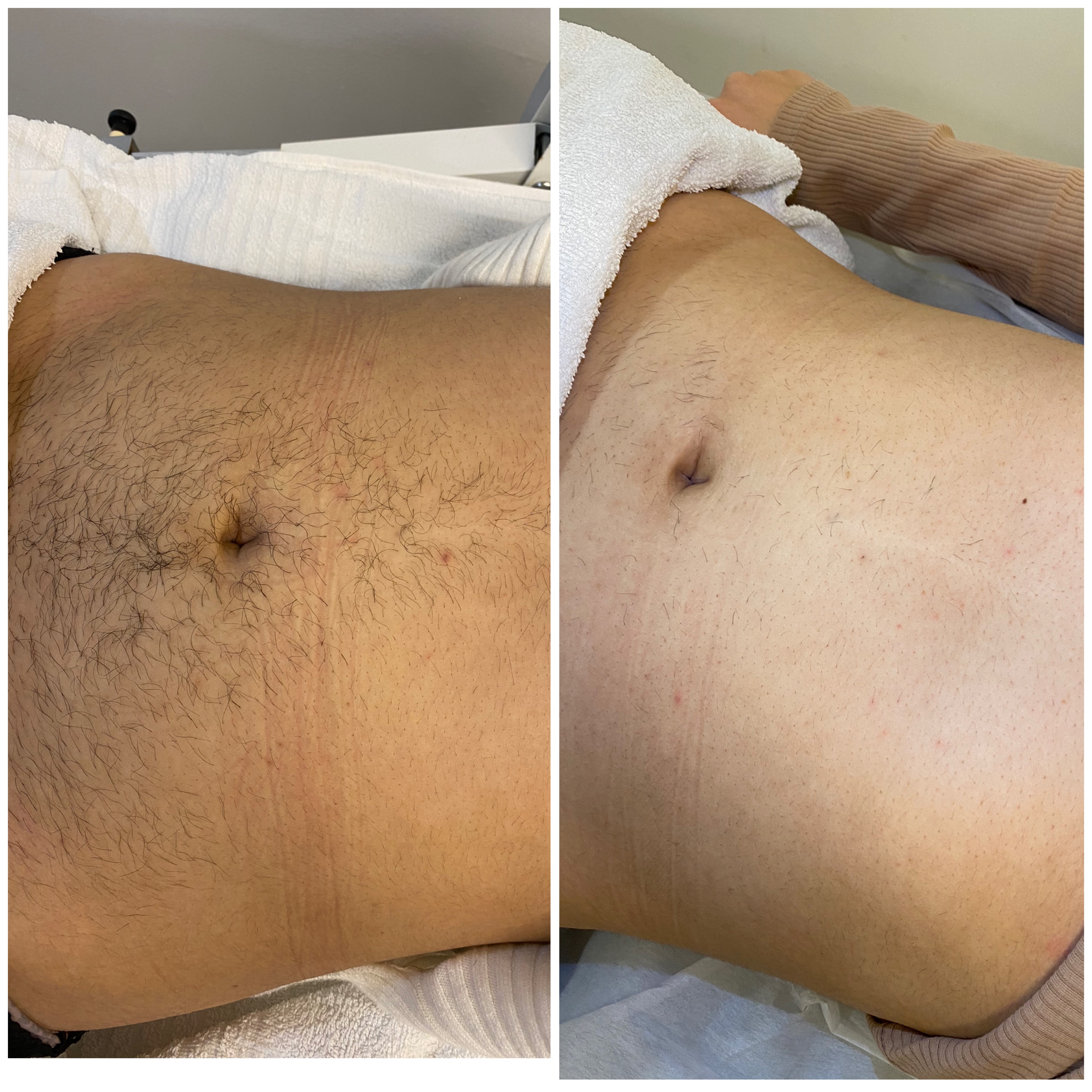 Laserbehandling — resultat 7